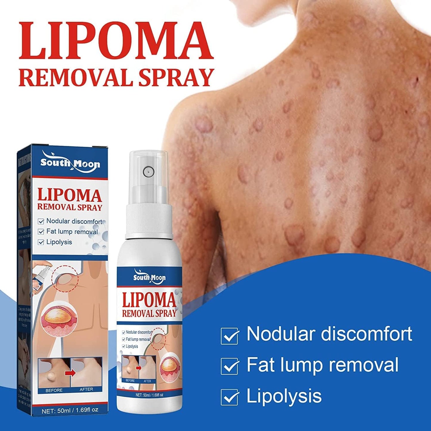 South Moon Lipoma Removal Spray লাইপোমা রিমুভাল স্প্রে 50g অপারেশন ছাড়াই লিপোমা দূরীকরণ