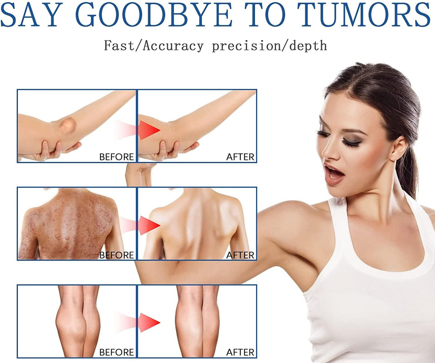 South Moon Lipoma Removal Spray লাইপোমা রিমুভাল স্প্রে 50g অপারেশন ছাড়াই লিপোমা দূরীকরণ