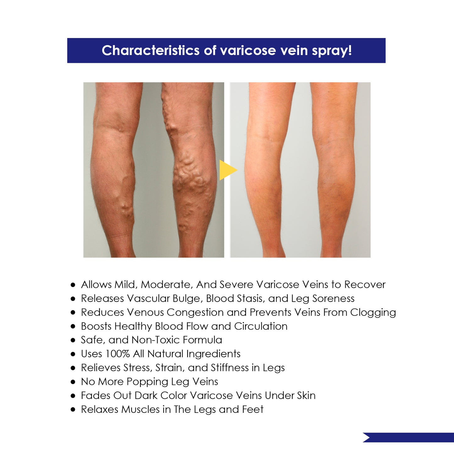 Varicose Veins Spray
