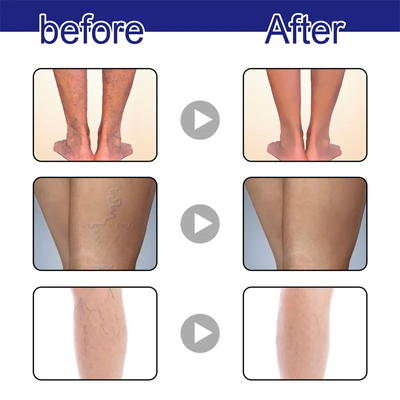 Varicose Veins Spray