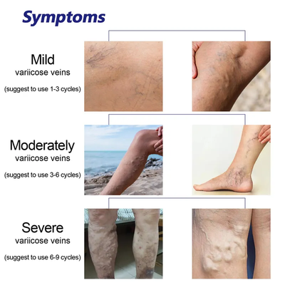 Varicose Veins Spray