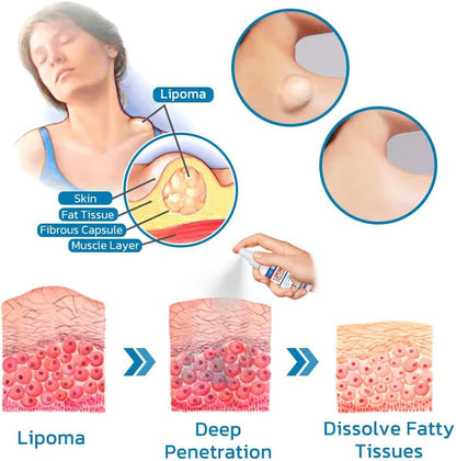 South Moon Lipoma Removal Spray লাইপোমা রিমুভাল স্প্রে 50g অপারেশন ছাড়াই লিপোমা দূরীকরণ