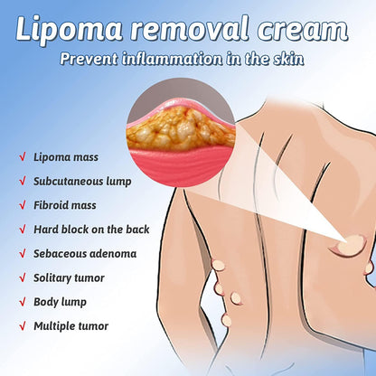 South Moon Lipoma Removal Spray লাইপোমা রিমুভাল স্প্রে 50g অপারেশন ছাড়াই লিপোমা দূরীকরণ