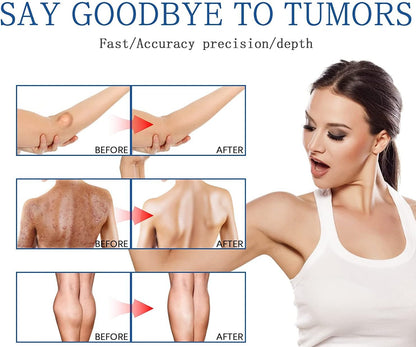 South Moon Lipoma Removal Spray লাইপোমা রিমুভাল স্প্রে 50g অপারেশন ছাড়াই লিপোমা দূরীকরণ