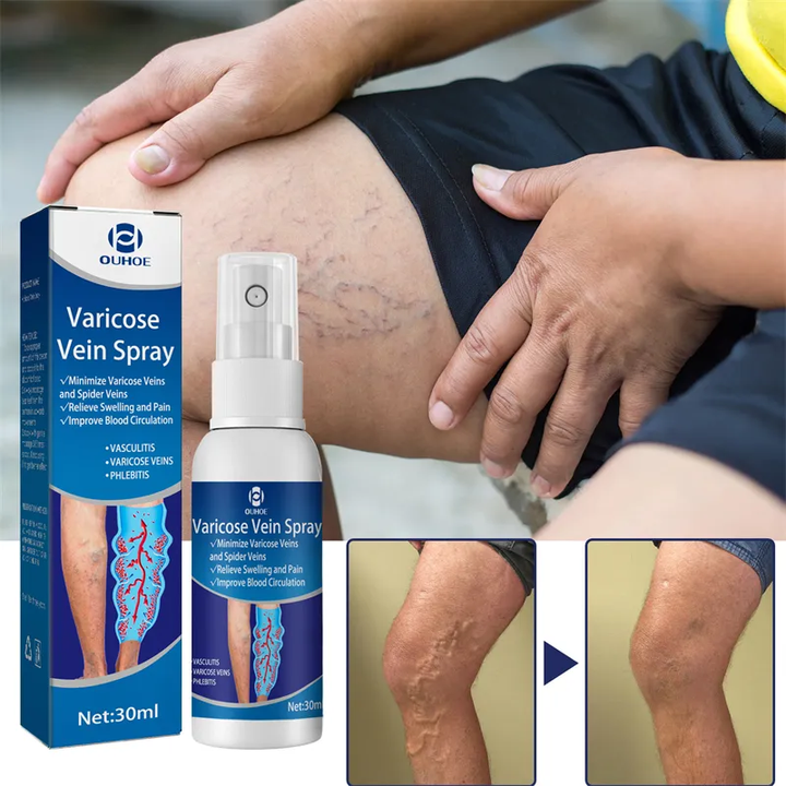 Varicose Veins Spray